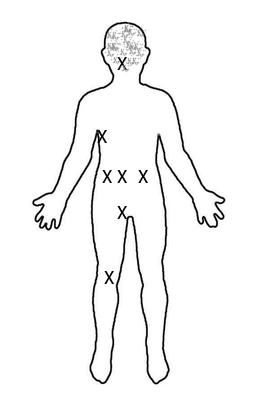 Common Tick Attachment Points